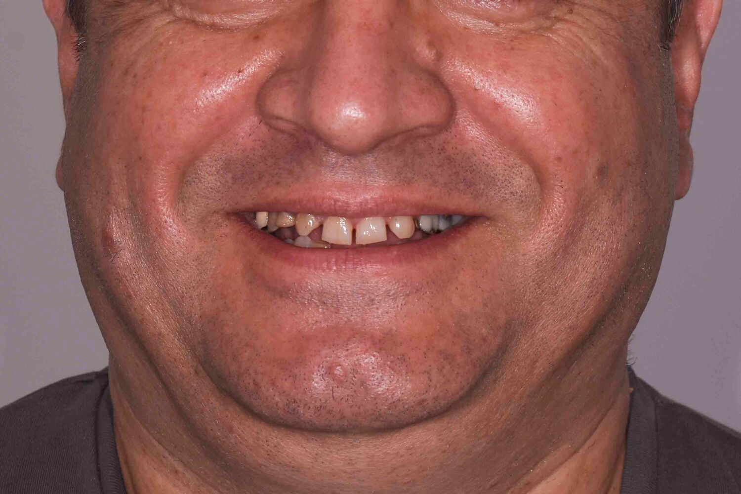 Pacient Clinica Dr. Alin Odor - Rezultat Implantologie